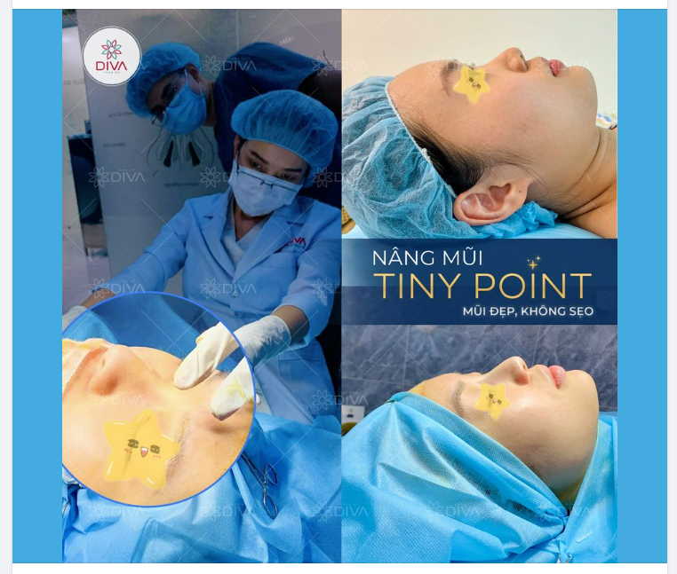 NÂNG MŨI TINYPOINT – PHƯƠNG PHÁP CHO MŨI ÍT KHUYẾT ĐIỂM
