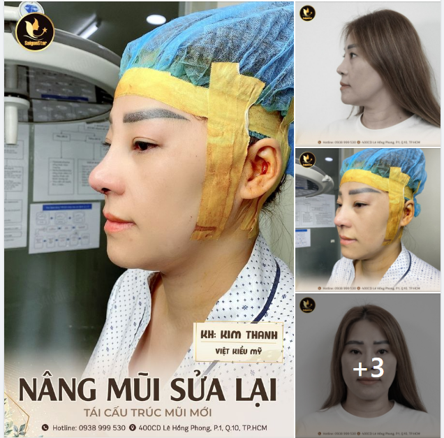 NÂNG MŨI XINH - TỰ TIN KHOE SẮC