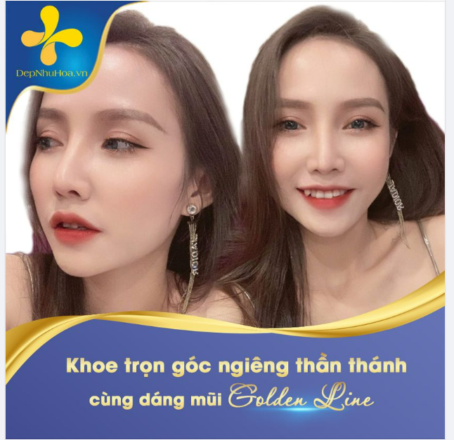 Nâng mũi xong diện mạo thần thái, cao sang hơn hẳn ạ