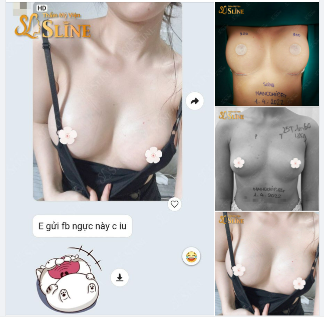 Nâng ngực xong ai cũng khen đẹp Khách hàng hài lòng còn chúng tôi thì thấy Hạnh Phúc!