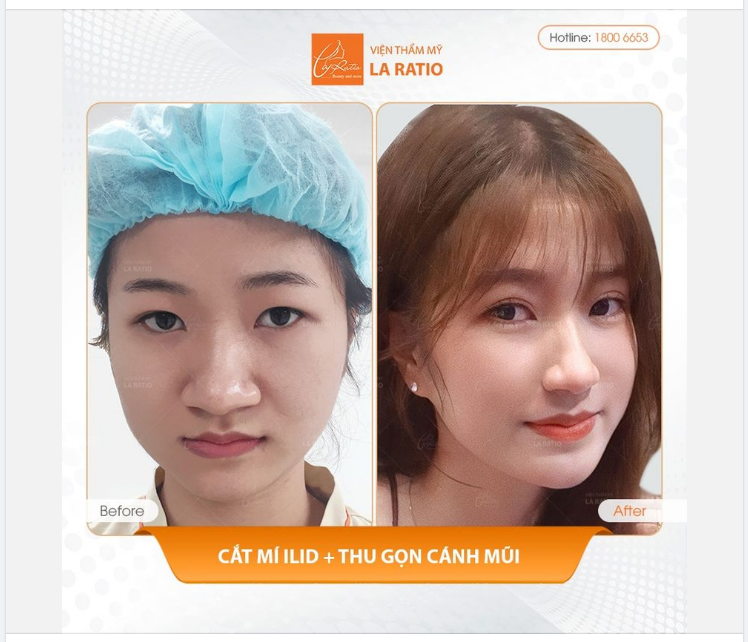 NÊN CẮT MÍ HAY NHẤN MÍ