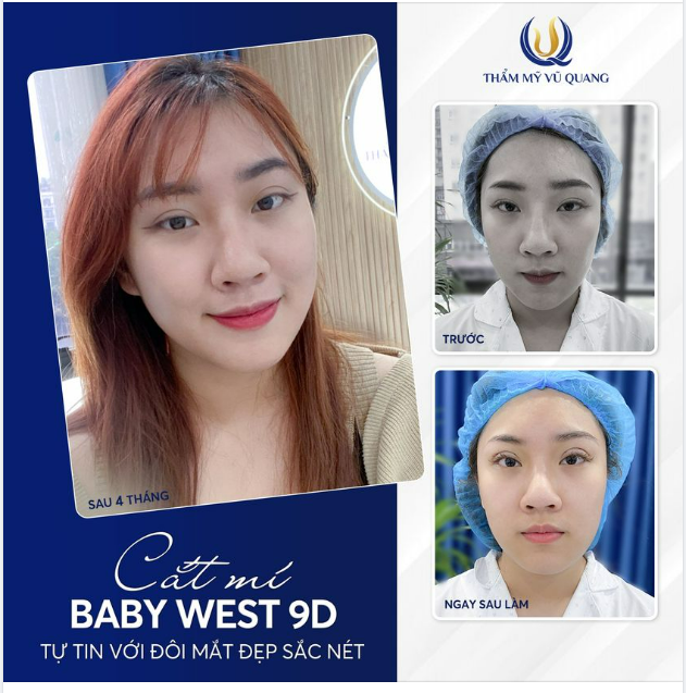 Nếp mí siêu xinh - Đôi mắt tâm tình.