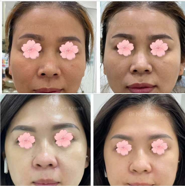 Nếu bạn đang nghĩ độn cằm chỉ để cằm bớt lẹm thôi thì bạn sai rồi.