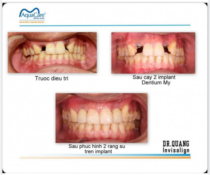 NẾU CUỘC SỐNG MỆT MỎI QUÁ, CẤY IMPLANT ĐÃ MỌI VIỆC TÍNH SAU