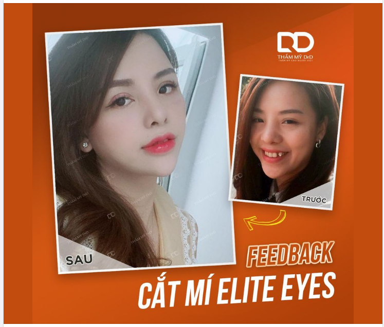 Nghe nói nàng thích nếp mí tự nhiên.. Thật tình cờ DrD lại có Cắt mí Elite Eyes