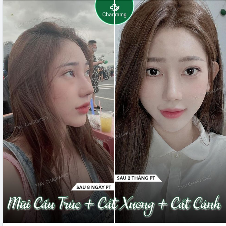 Người ta bảo mũi cấu trúc sụn sườn, cắt xương, cắt cánh là phải chờ lâu mới hồi phục và lên form được.