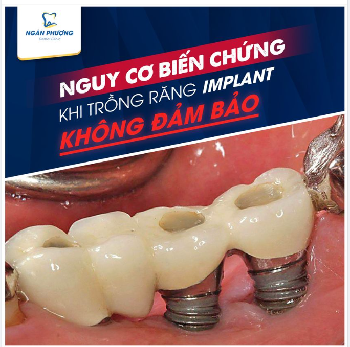 NGUY CƠ BIẾN CHỨNG KHI TRỒNG RĂNG IMPLANT KHÔNG ĐẢM BẢO