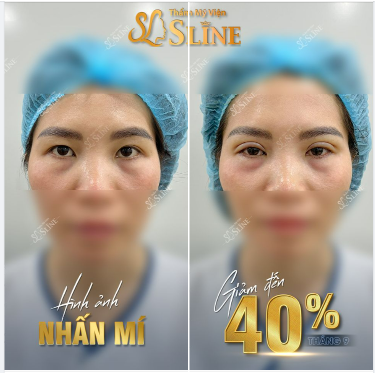 Nhấn mí 7 điểm Hình ảnh khách hàng vừa thực hiện xong bởi Ekip Sline