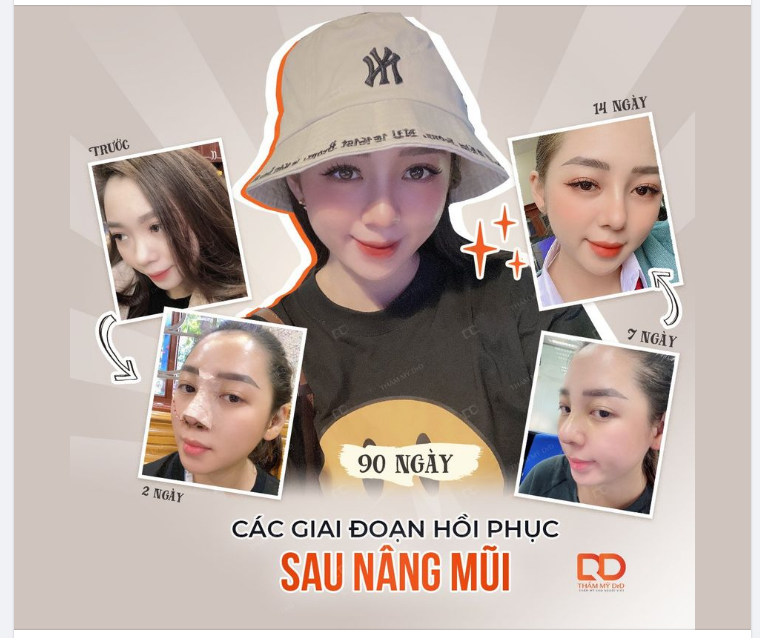 NHẬT KÝ 90 NGÀY HỒI PHỤC SAU NÂNG MŨI.