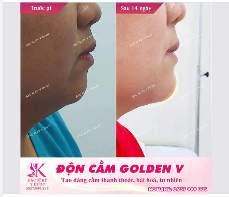 Nhiều bạn nhận xét trông em xinh hơn nhưng lại không biết em đã thay đổi gì sau khi ĐỘN CẰM GOLDEN - V