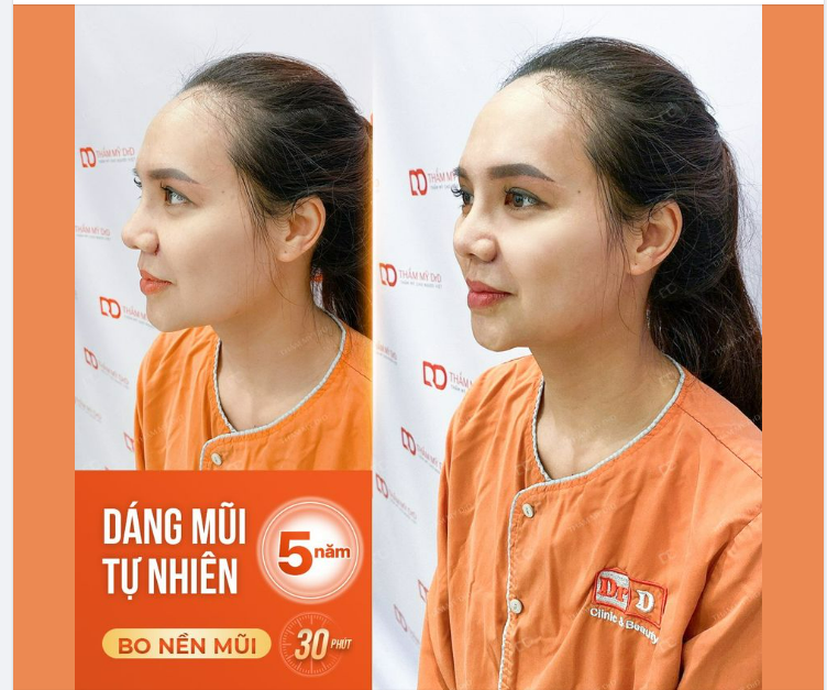 Nhiều khách hàng lo lắng rằng Nâng mũi Sline sau 5 năm, 10 năm liệu có còn đẹp không