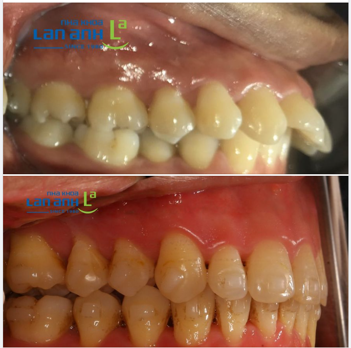 Nhiều người nói niềng Invisalign không niềng được những ca hô nhiều, những ca khó, phức tạp,...