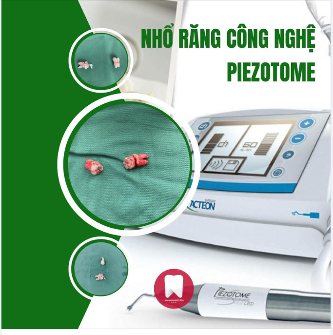 NHỔ RĂNG KHÔN KHÔNG ĐAU VỚI MÁY SIÊU ÂM PIEZOTOME