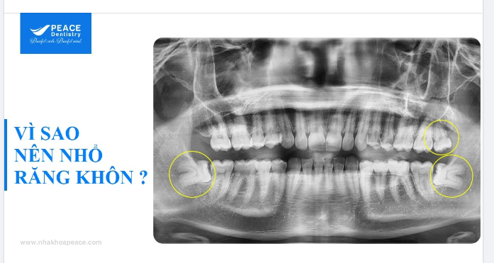 NHỔ RĂNG KHÔN LÀ BẢO VỆ SỨC KHOẺ RĂNG MIỆNG VÀ TOÀN THÂN