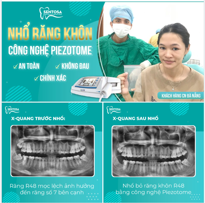 NHỔ RĂNG KHÔN LỆCH 90 ĐỘ - TRÁNH NGUY CƠ ẢNH HƯỞNG ĐẾN RĂNG SỐ 7