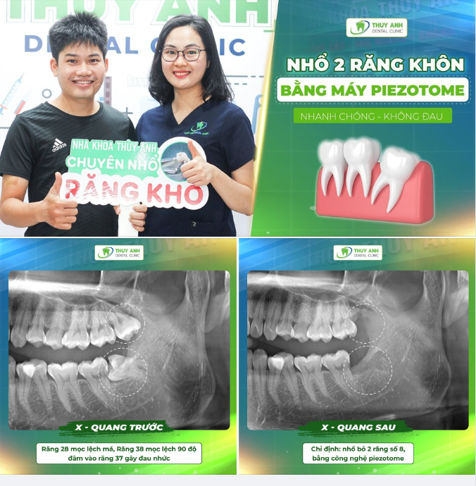 NHỔ RĂNG KHÔN MỌC LỆCH - TRÁNH NGUY CƠ ẢNH HƯỞNG ĐẾN RĂNG SỐ 7