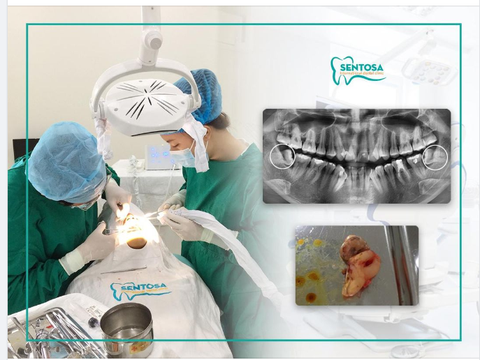 NHỔ RĂNG KHÔN SIÊU NHANH MÀ LẠI TIẾT KIỆM