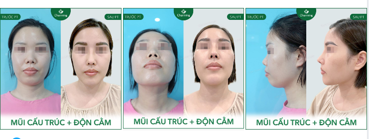 Những ca mũi khó, thấp, hếch nhiều thì làm sao thoát được phẫu thuật nâng mũi cấu trúc sụn sườn