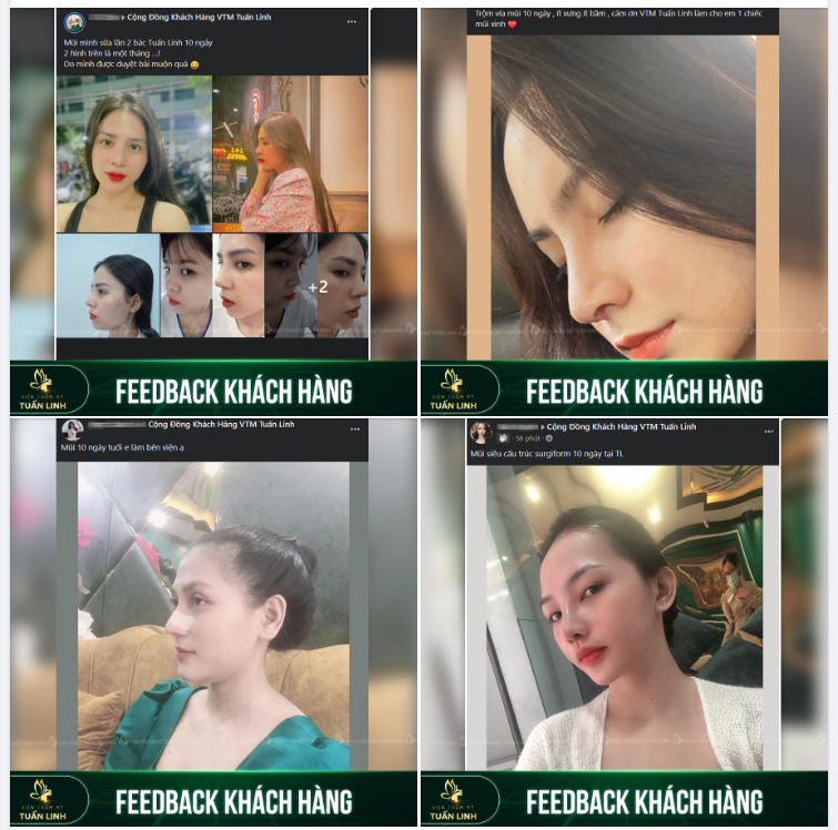 Những chiếc mũi chỉ sau 10 ngày đã thực sự làm khách hàng hài lòng rồi. Cùng tham khảo feedback của các bạn ấy ngay nha!