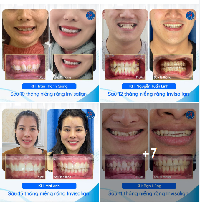 NHỮNG CON SỐ BIẾT NÓI - CHỈNH NHA INVISALIGN TẠI NHA KHOA PHƯƠNG NAM