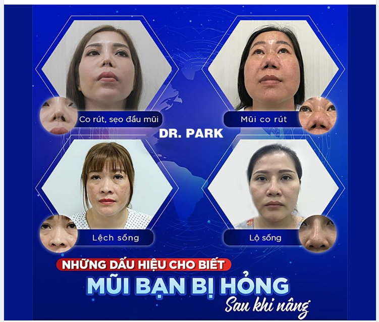 NHỮNG DẤU HIỆU CHO BIẾT MŨI BẠN BỊ HỎNG SAU NÂNG!