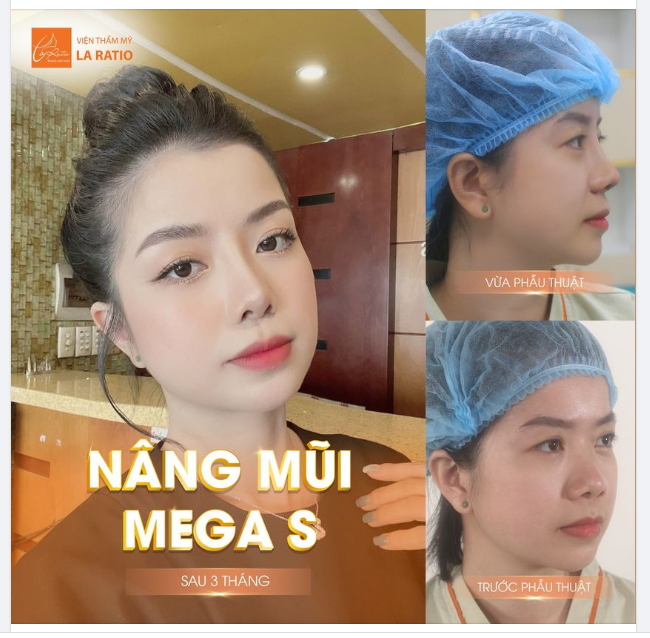 NHỮNG ĐIỀU CẦN LƯU Ý TRƯỚC KHI NÂNG MŨI