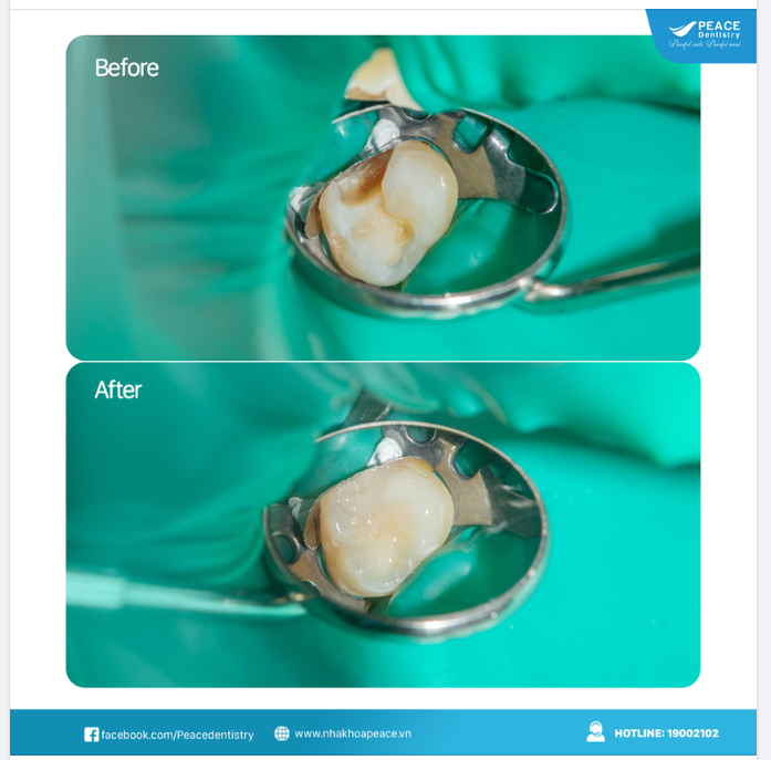 NHỮNG TRƯỜNG HỢP CHỈ ĐỊNH TRÁM RĂNG
