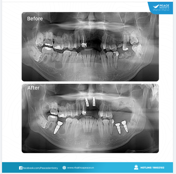 NHỮNG  ƯU ĐÃI HẤP DẪN TRỒNG RĂNG IMPLANT TẠI PEACE DENTISTRY