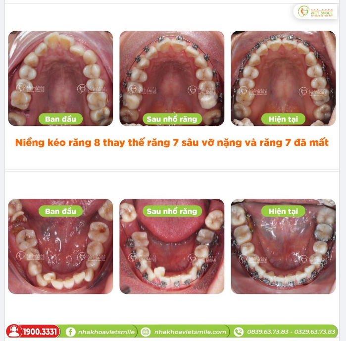 NIỀNG KÉO RĂNG 8 THAY THẾ RĂNG 7 SÂU VỠ NẶNG VÀ RĂNG 7 ĐÃ MẤT