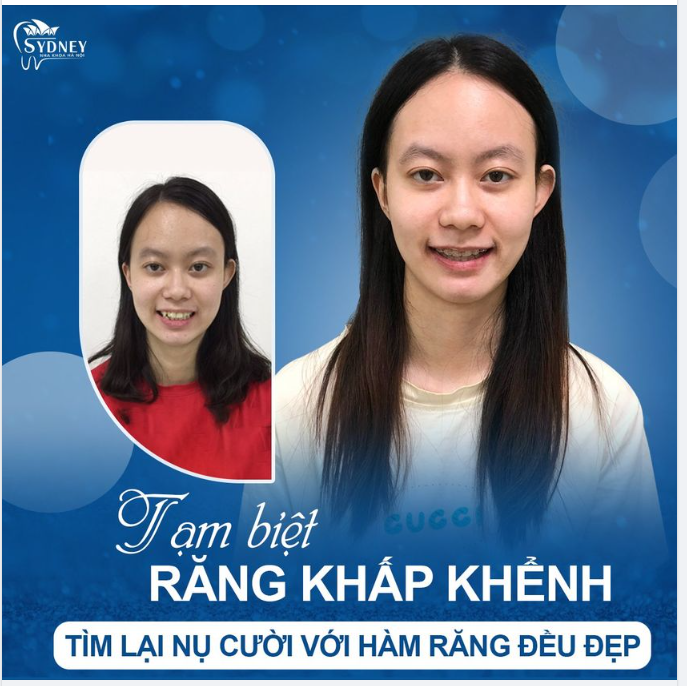 NIỀNG RĂNG - BÍ QUYẾT TẠM BIỆT HÀM RĂNG KHẤP KHỂNH