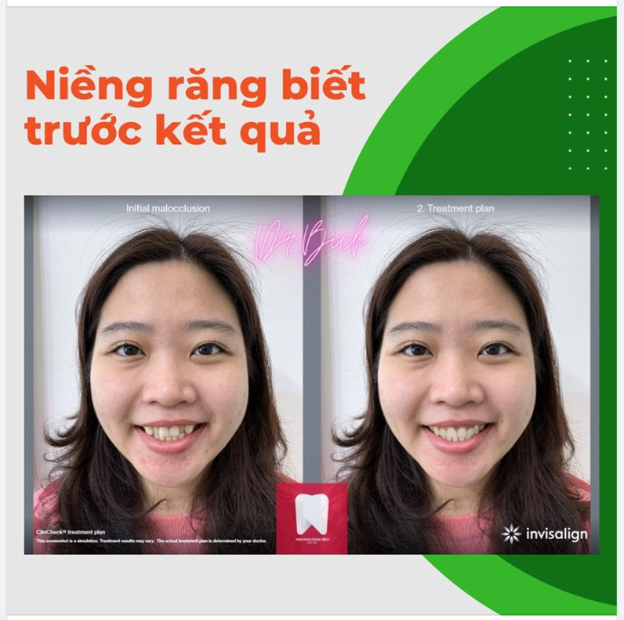 NIỀNG RĂNG BIẾT TRƯỚC KẾT QUẢ NGAY SAU 1 LẦN HẸN