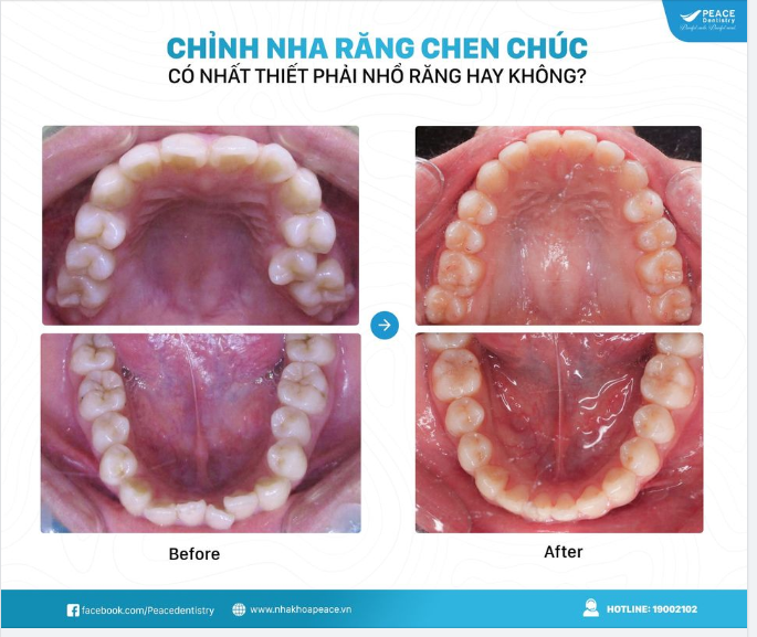NIỀNG RĂNG CHEN CHÚC (RĂNG KHẤP KHỂNH) CÓ NHẤT THIẾT PHẢI NHỔ RĂNG?