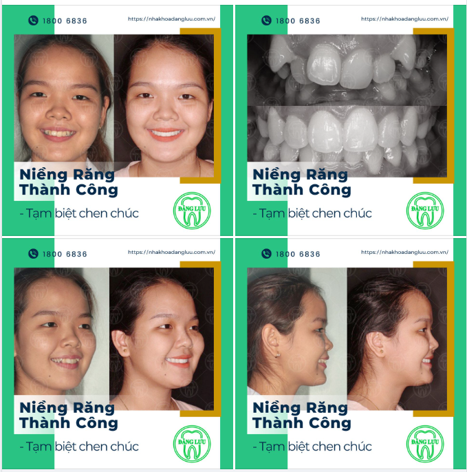 NIỀNG RĂNG CHEN CHÚC