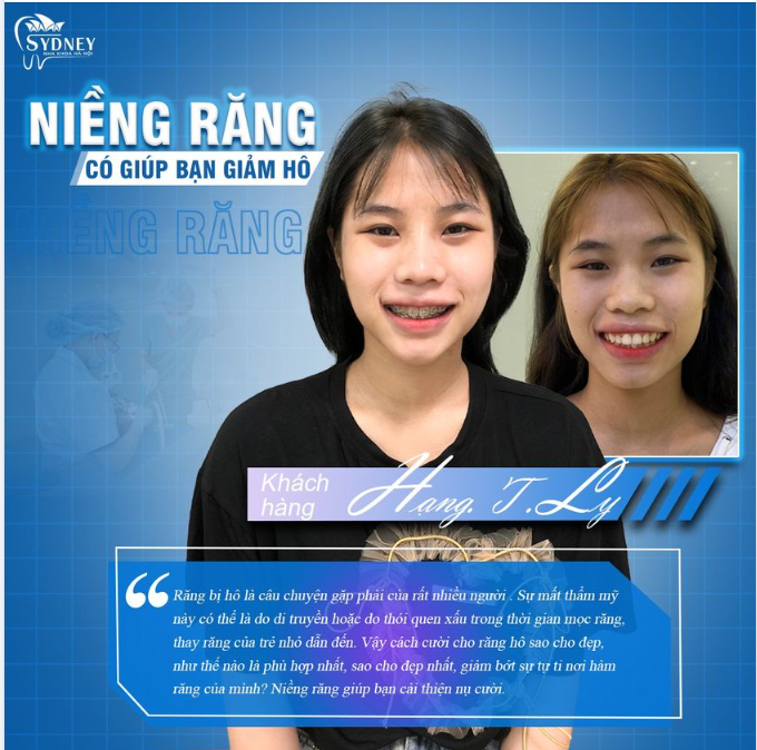 Niềng răng có giúp bạn giảm hô?