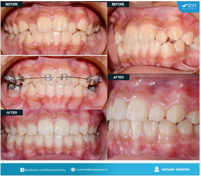 NIỀNG RĂNG CÓ THỂ NHANH HƠN BẠN NGHĨ