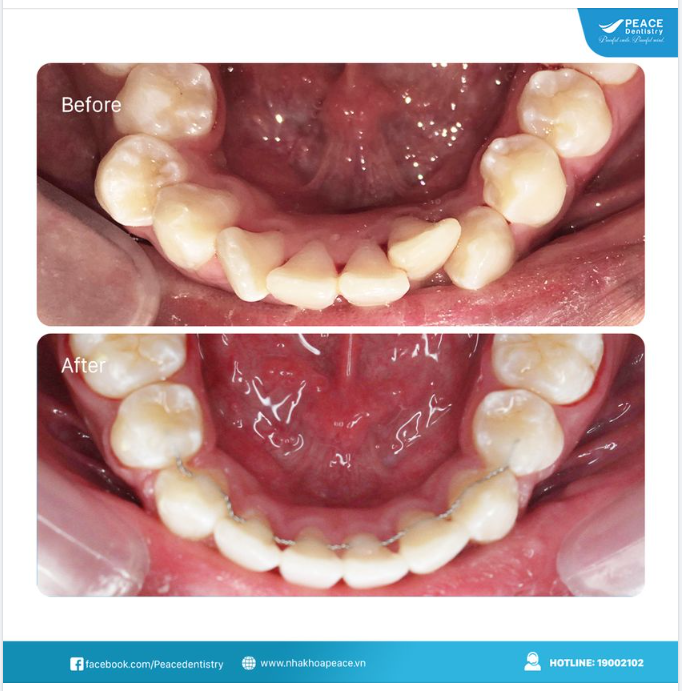 NIỀNG RĂNG ĐỂ CƯỜI TỰ TIN HƠN