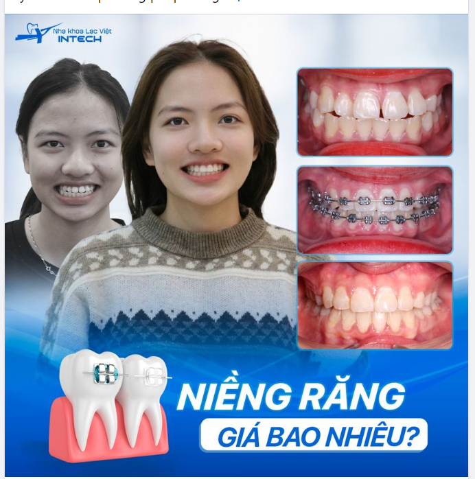 NIỀNG RĂNG GIÁ BAO NHIÊU?