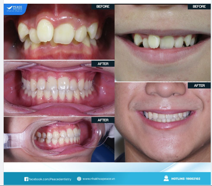 NIỀNG RĂNG GIẢI PHÁP TỐI ƯU CHO RĂNG CHEN CHÚC KHẤP KHỂNH