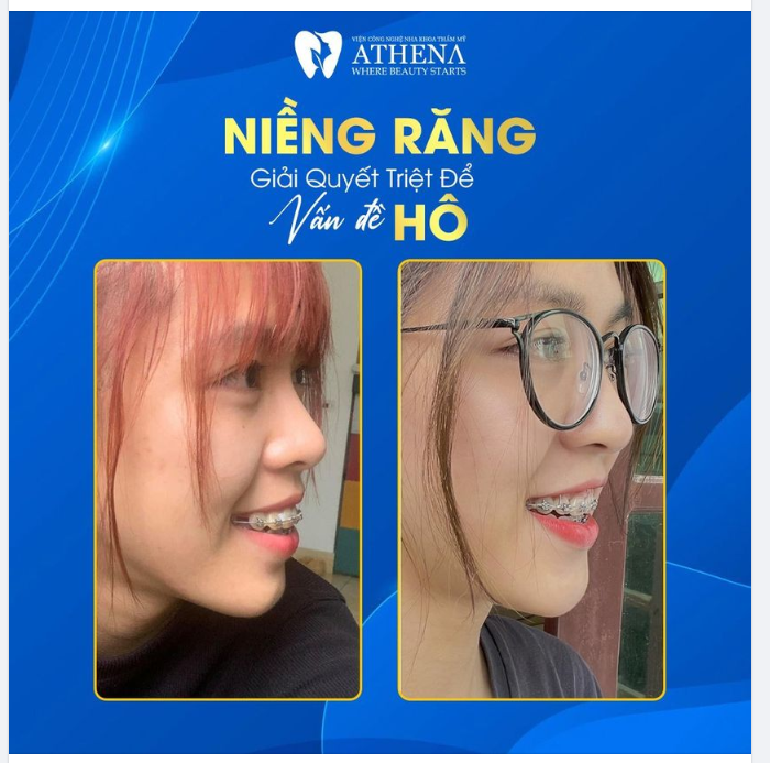 NIỀNG RĂNG - GIẢI QUYẾT VẤN ĐỀ HÔ