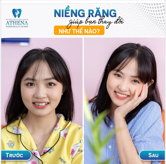NIỀNG RĂNG GIÚP BẠN THAY ĐỔI NHƯ THẾ NÀO?