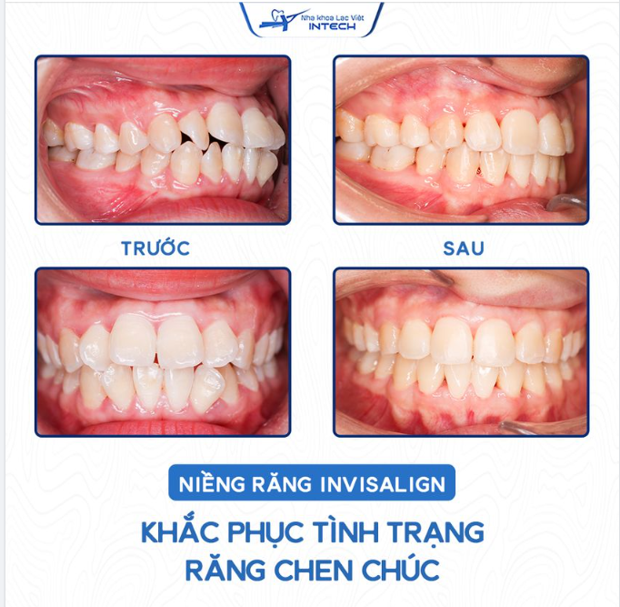 NIỀNG RĂNG INVISALIGN – KHẮC PHỤC HOÀN TOÀN RĂNG CHEN CHÚC