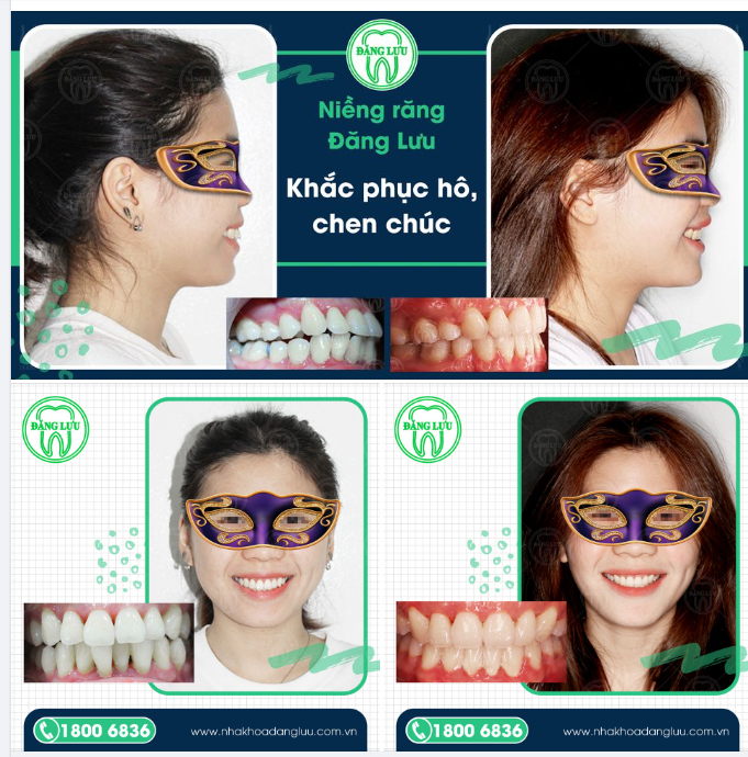 NIỀNG RĂNG KHẮC PHỤC RĂNG HÔ CHEN CHÚC
