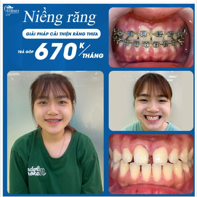 Niềng răng lãi suất 0% – Giải pháp cải thiện răng thưa