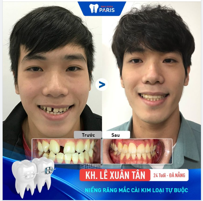 Niềng răng mắc cài kim loại tự buộc