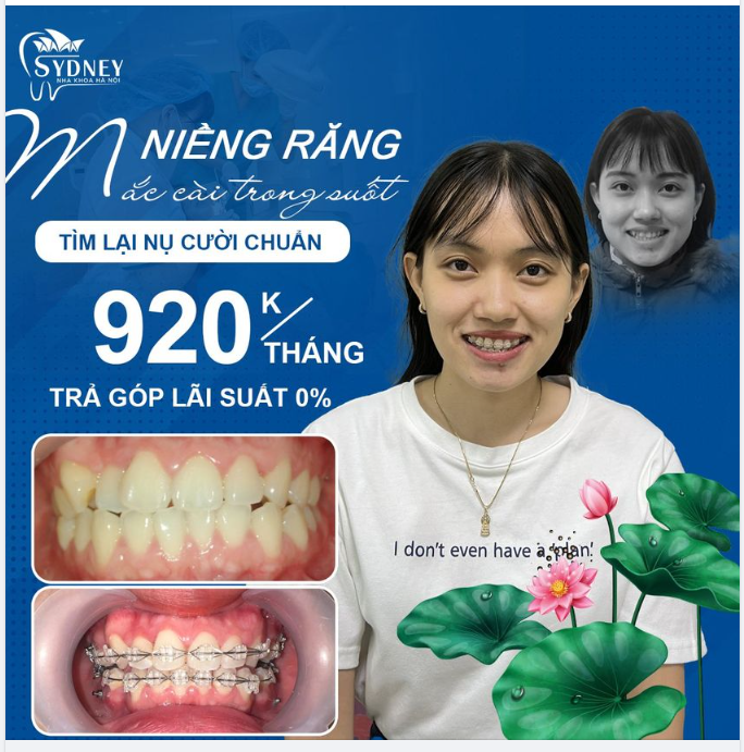 Niềng răng mắc cài pha lê là gì?