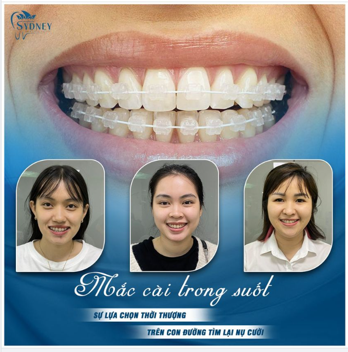 Niềng răng mắc cài pha lê trong suốt – Hiệu quả cao, thẩm mỹ tuyệt vời