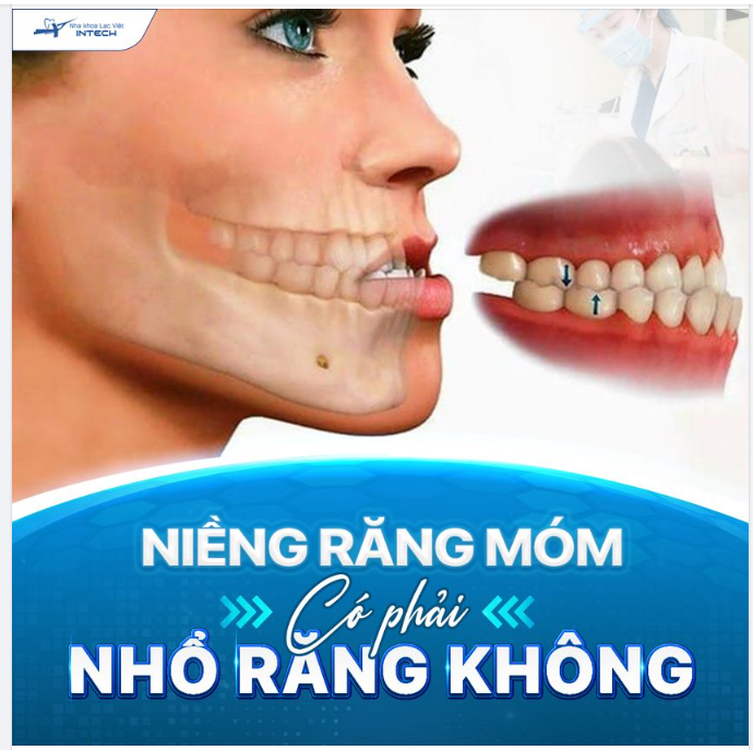 NIỀNG RĂNG MÓM CÓ PHẢI NHỔ RĂNG KHÔNG?