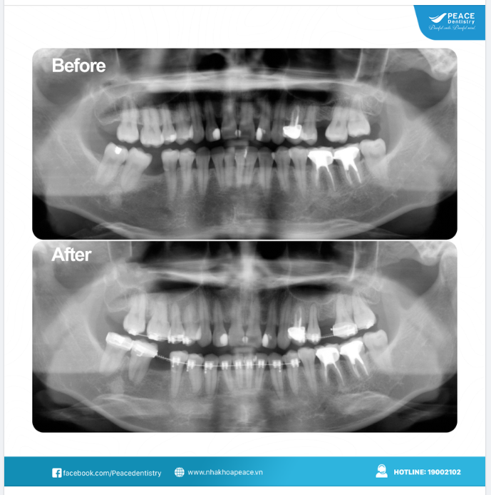 ​​​​​​​NIỀNG RĂNG TẠO KHOẢNG CẤY GHÉP IMPLANT