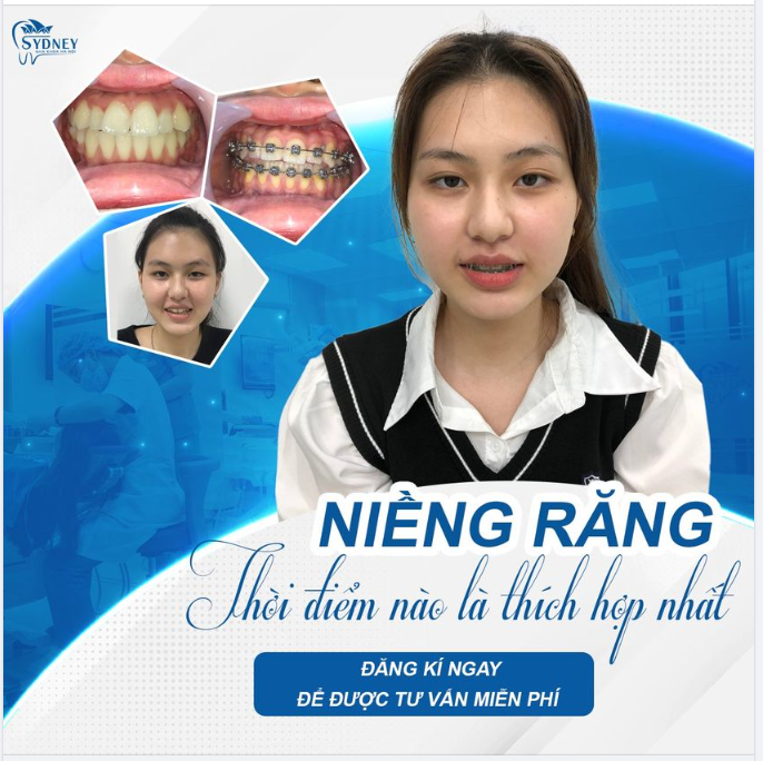 Niềng răng thời điểm nào là thích hợp nhất?