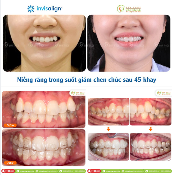 NIỀNG RĂNG TRONG SUỐT GIẢM CHEN CHÚC SAU 45 KHAY